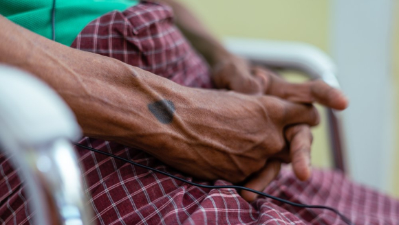 Ein tätowiertes Herz auf der Hand eines Patienten, der in unserer mobilen Klinik behandelt wird. 