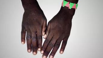 Ärzte ohne Grenzen Niger psychosoziale Hilfe