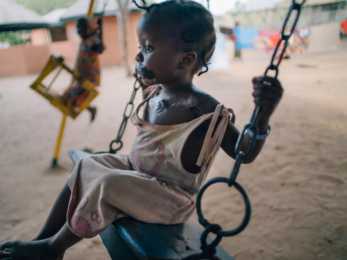 Die vierjährige Maryam wurde aufgrund ihrer Noma-Erkrankung im Krankenhaus in Sokoto operiert