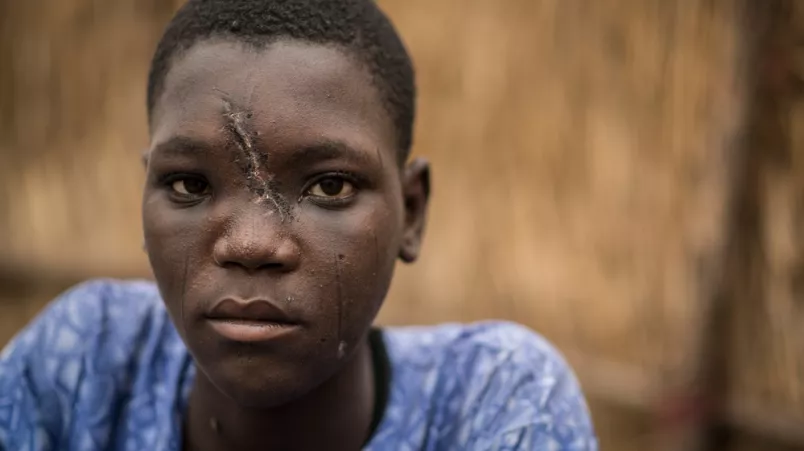 Nigeria Boko Haram Vetriebener mit Schussverletzung