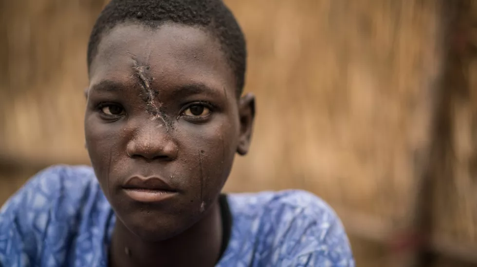 Nigeria Boko Haram Vetriebener mit Schussverletzung