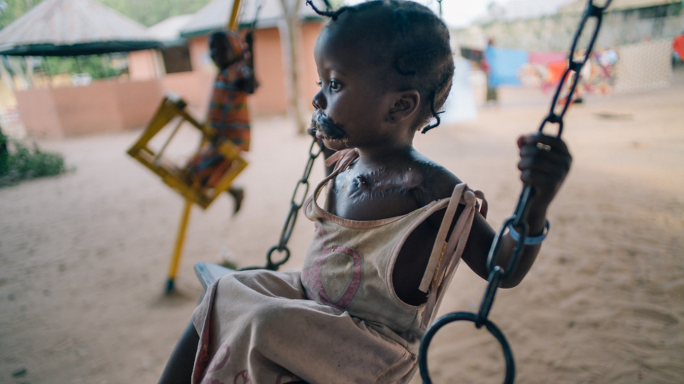 Noma Patientin im Kinderkrankenhaus Sokoto