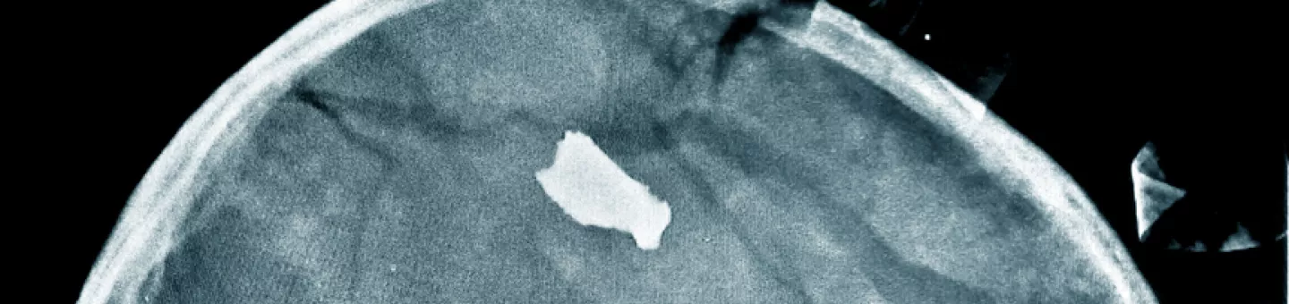 Röntgenbild eines 20 Monate alten Kleinkindes mit einem Granatsplitter im Kopf