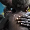 Kongo Mangelernährung Ärzte ohne Grenzen