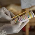 Ein Hepatitis E Test
